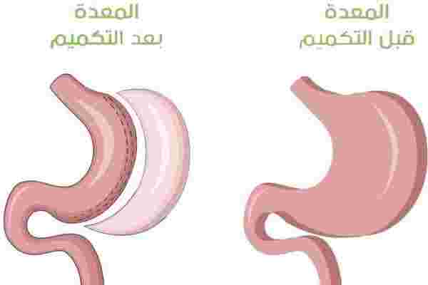 متى تلتئم المعده بعد التكميم