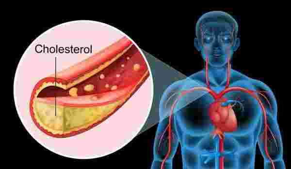أسباب ارتفاع الكوليسترول