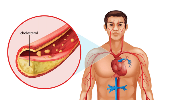 أعراض ارتفاع الكوليسترول والدهون الثلاثية