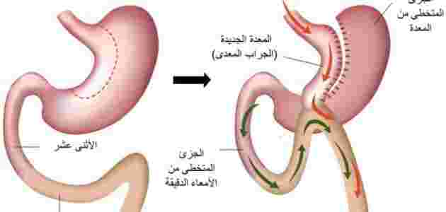 تجارب عملية تحويل مسار المعدة