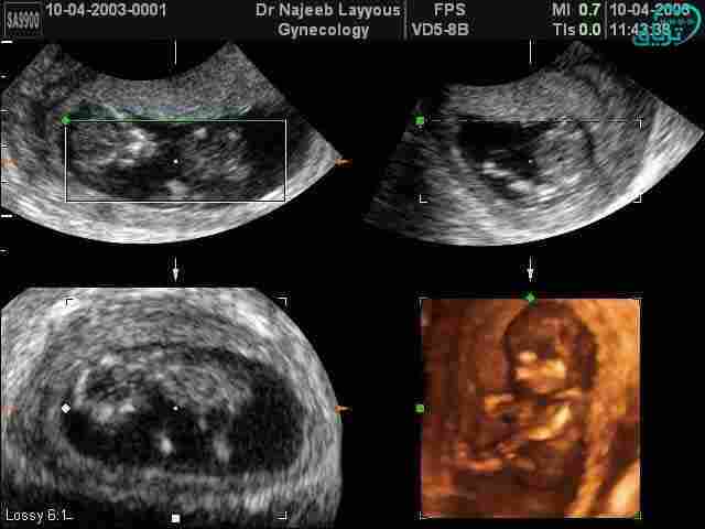 شكل الجنين في الاسبوع العاشر بالسونار