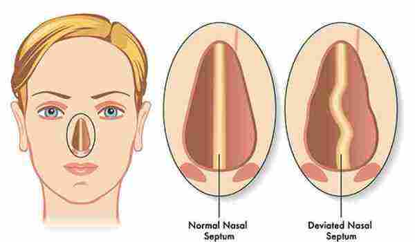 أعراض انحراف الحاجز الأنفي