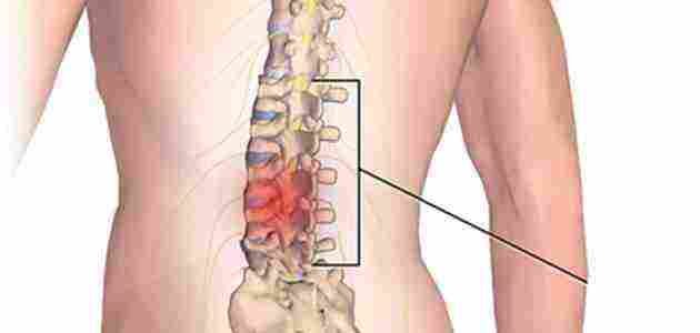 علاج الانزلاق الغضروفي في اسفل الظهر
