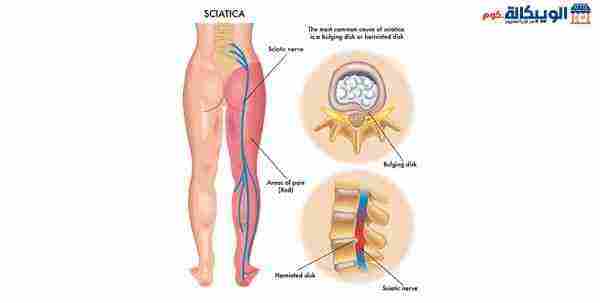 اسباب الم الساقين من الخلف