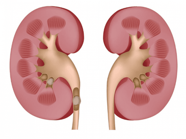 علاج حصى الكلى طبيعيًا في المنزل