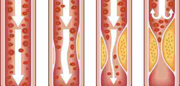 علاج الدهون الثلاثيه والكلسترول وتصلب الشرايين خلال اسبوعين
