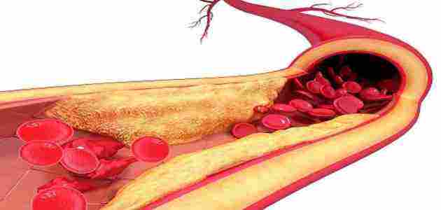 علاج الدهون الثلاثيه والكلسترول وتصلب الشرايين خلال اسبوعين