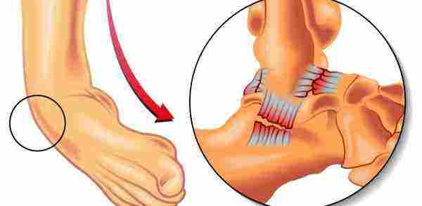 مضاعفات التواء الكاحل