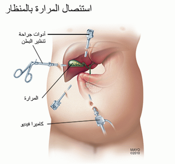 أسباب آلام الكبد بعد استئصال المرارة