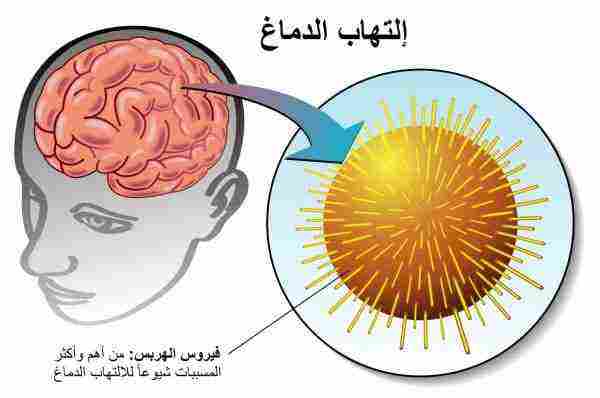 أعراض مرض الأعصاب في الرأس