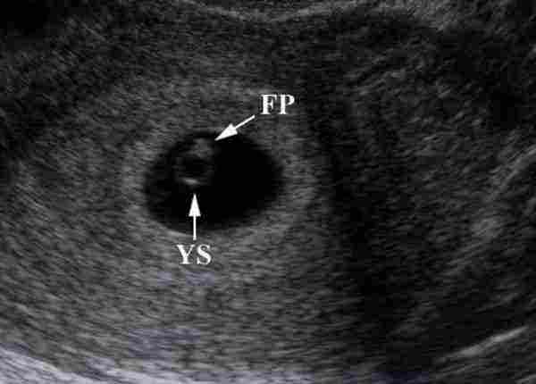 متى يظهر الجنين في كيس الحمل في أي أسبوع