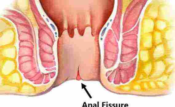 أفضل تجربة لعلاج الشرخ الشرجي