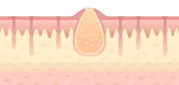 علاج واسباب ظهور الدمامل في المناطق الحساسة