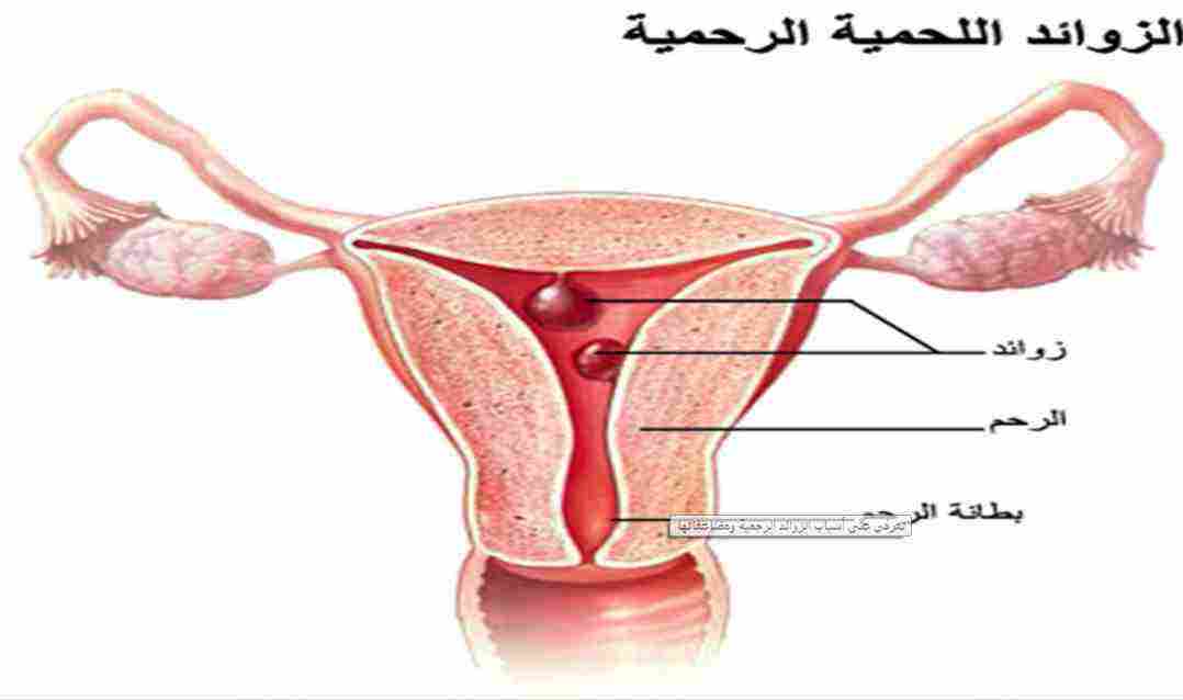 أسباب ظهور لحمية عنق الرحم