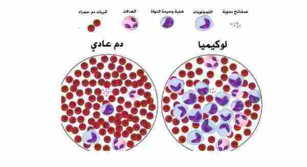 مريض سرطان الدم كم يعيش؟