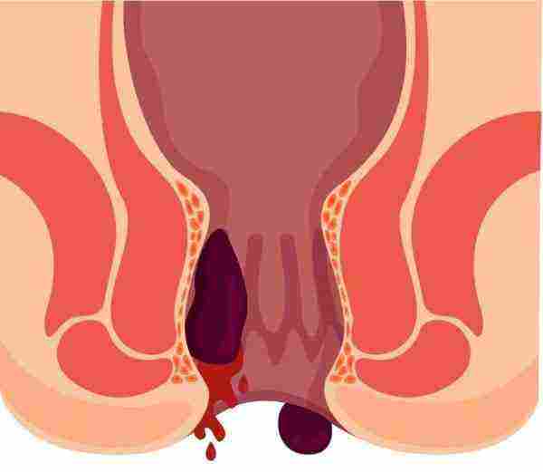 الطريقة الفعالة لاستعمال علاج البواسير