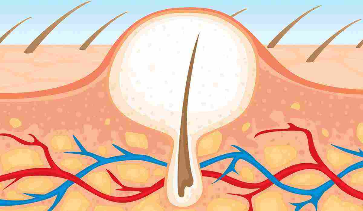 طرق إزالة الشعر من المنطقة الحساسة