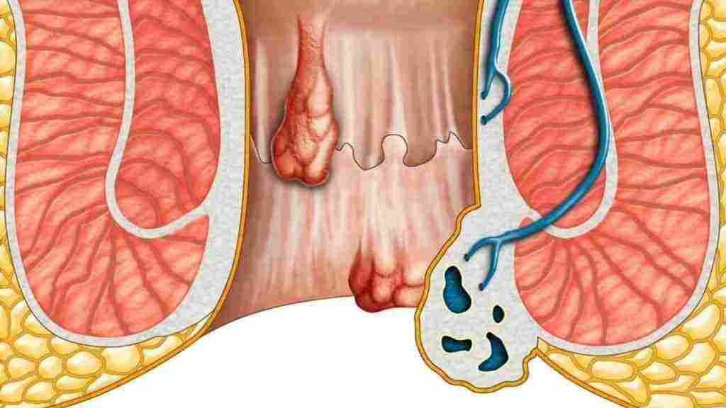 علاج جرح الدبر بالأعشاب