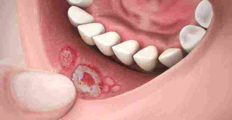 علاج قرح الفم المتكررة