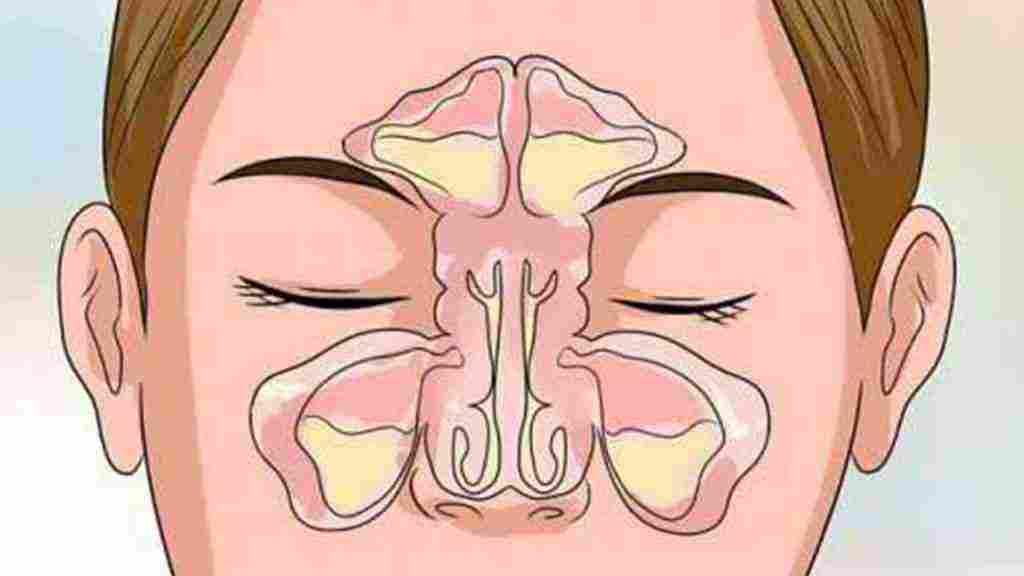 علاج احتقان الأنف المزمن
