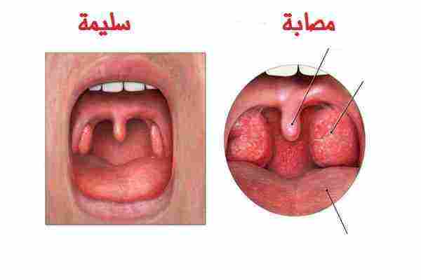 علاج احتقان الحلق للاطفال