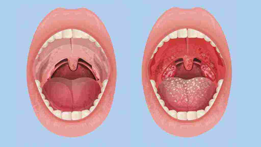 علاج التهاب الحلق واللوز