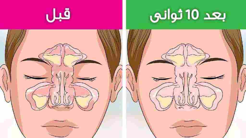 علاج الجيوب الانفية للحامل