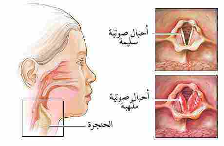 علاج بحة الصوت والتهاب الحلق