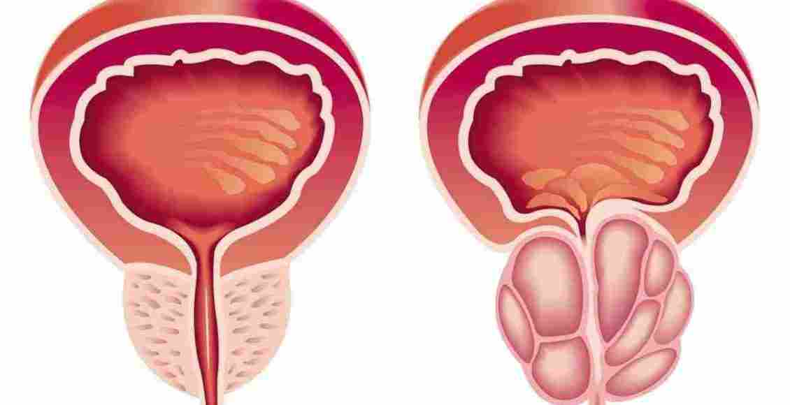 أعراض تضخم البروستاتا