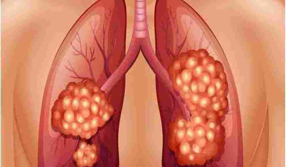 سرطان الرئة المرحلة الاخيرة
