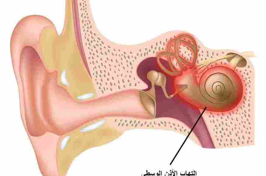 ما هي أعراض التهاب الأذن الوسطى