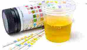 Complete urinalysis