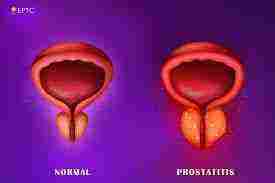 علاج التهاب البروستاتا نهائيا
