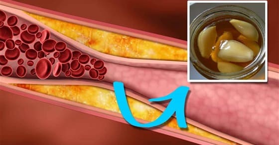 علاج الدهون الثلاثية بالثوم