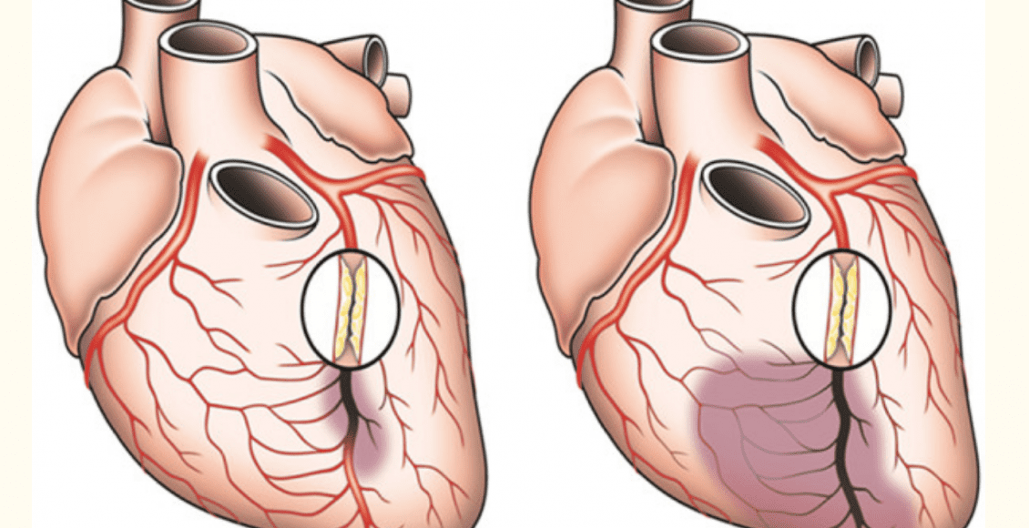 اعراض انسداد شرايين القلب