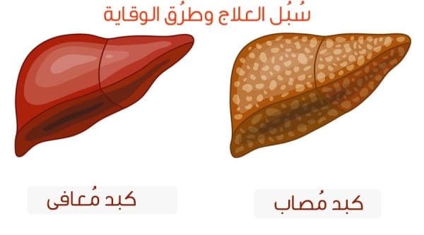 أعراض الدهون على الكبد