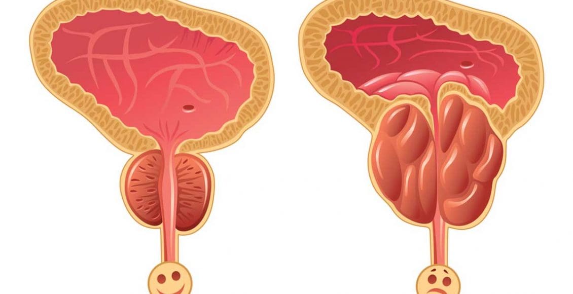 علاج البروستاتا بالطب النبوي