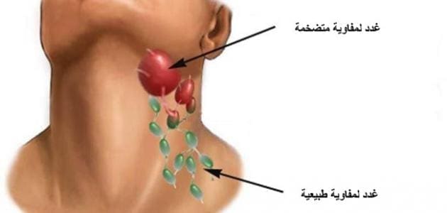 علاج التهاب الغدد اللمفاوية