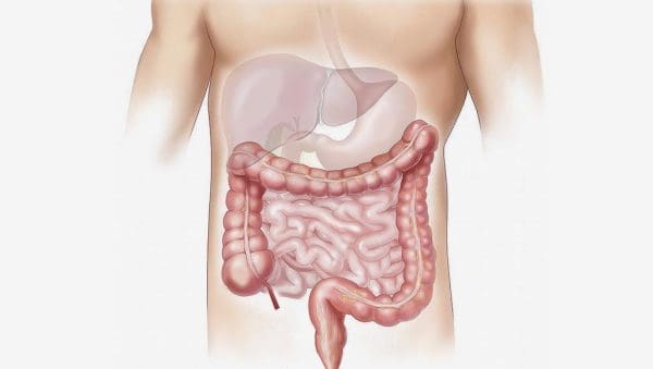 علاج الزائدة الدودية بالأعشاب