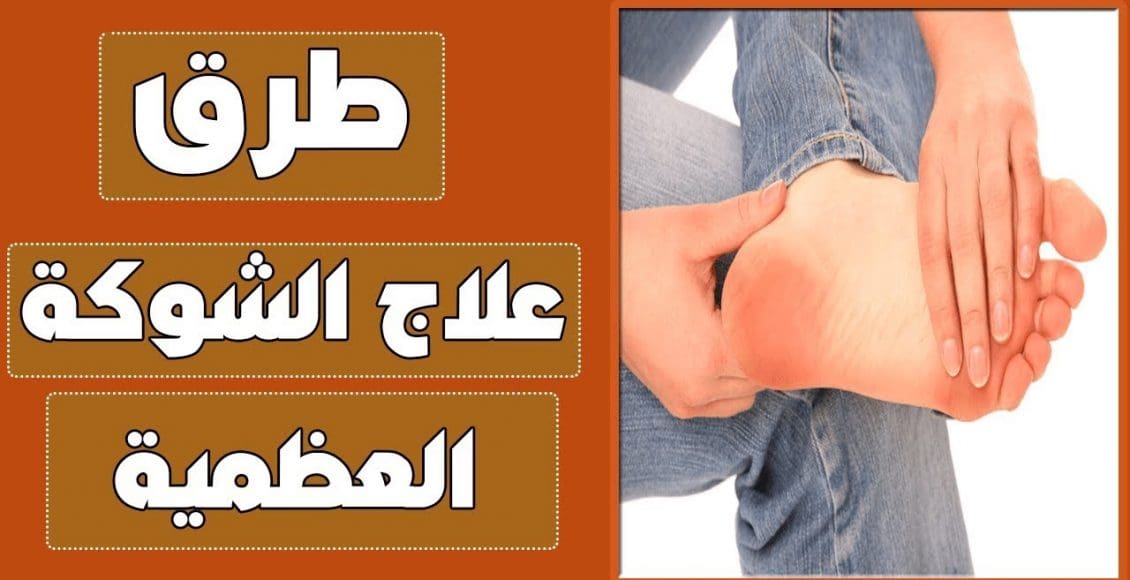 علاج الشوكة العظمية في المنزل