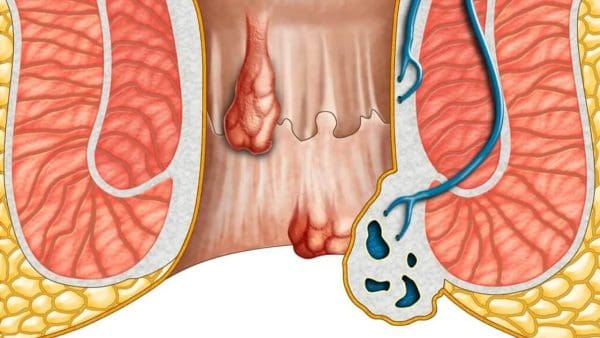 علاج حرقان فتحة الشرج