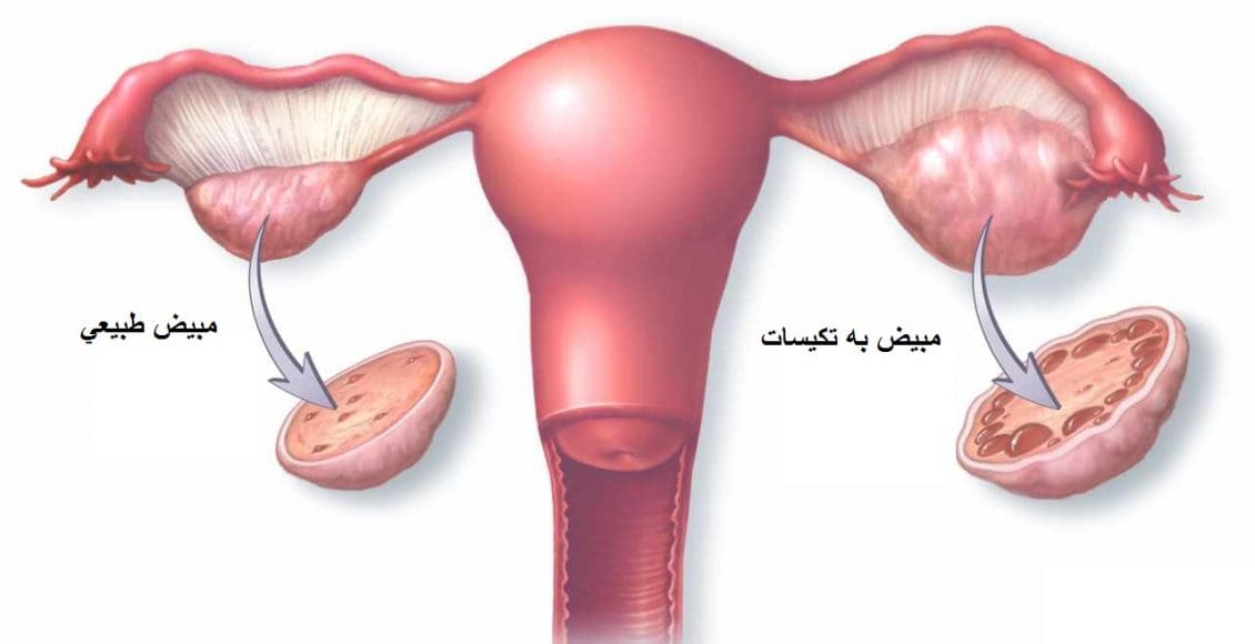 علاج تكيس المبايض بالبردقوش