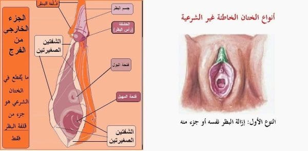 مراحل شفاء الختان بالصور للذكور والإناث