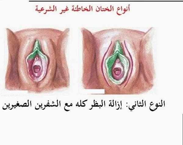 مراحل شفاء الختان بالصور للذكور والإناث