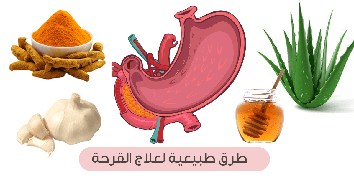 أعشاب لعلاج قرحة المعدة في المنزل