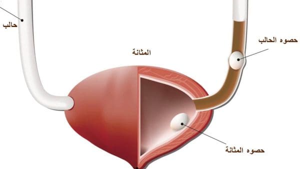 أعراض نزول الحصوة مع البول