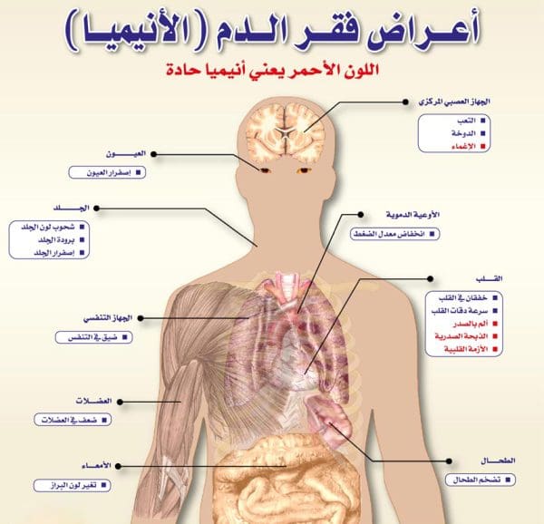 كيف أعرف فقر الدم من العين 