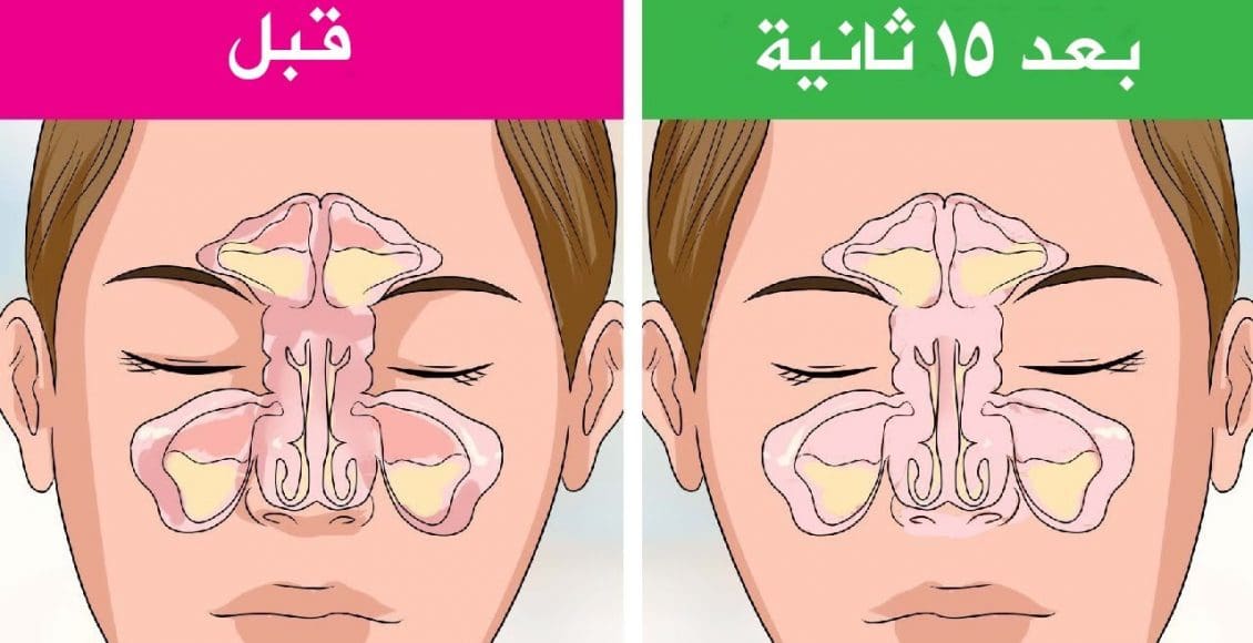 علاج لحمية الأنف بالأعشاب