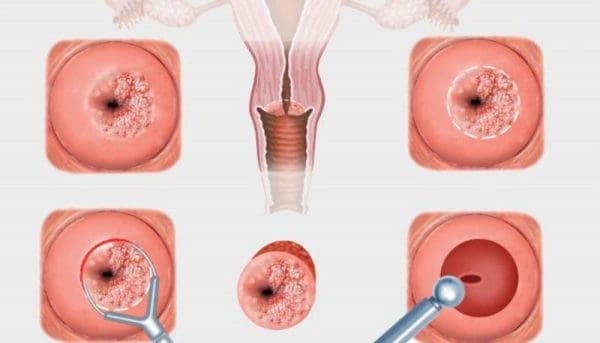 تجربتي في علاج قرحة الرحم