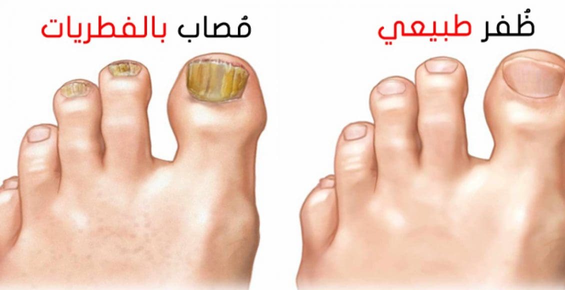 تجربتي مع فطريات الأظافر